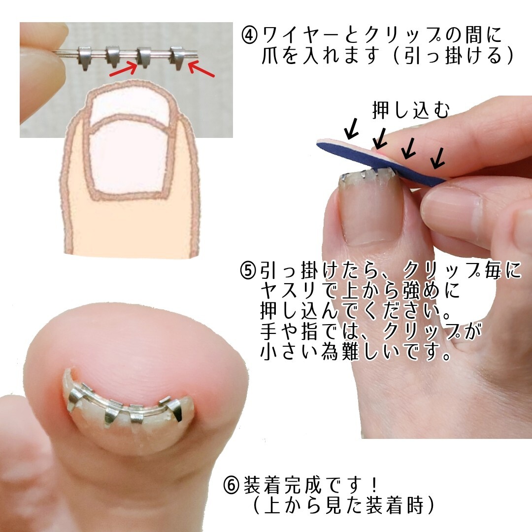 巻き爪矯正　セルフケア　ワイヤー　クリップ　陥入爪　巻き爪　フットケア　ネイルケア　巻き爪ケア　まきづめ　爪ケア_画像4
