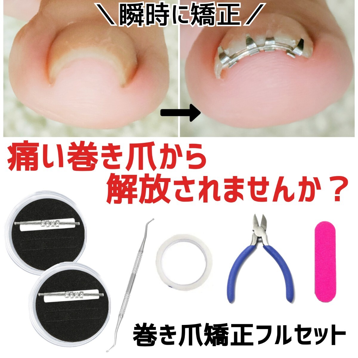 巻き爪矯正　セルフケア　ワイヤー　クリップ　陥入爪　巻き爪　フットケア　ネイルケア　巻き爪ケア　まきづめ　爪ケア_画像1