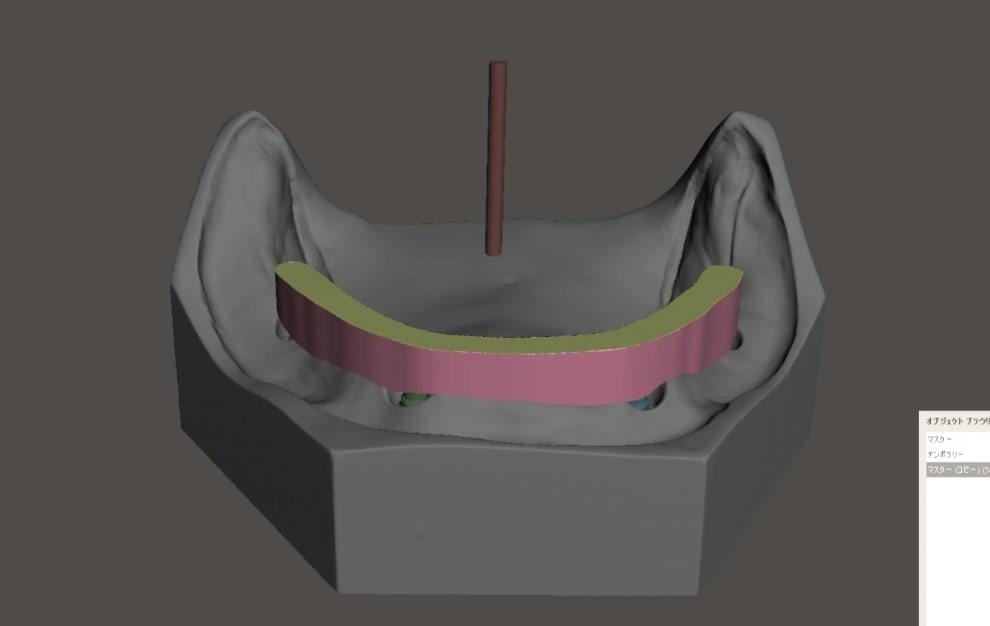 歯科　歯科技工　インプラントバー構造データ作成手順　mp4動画　_画像3