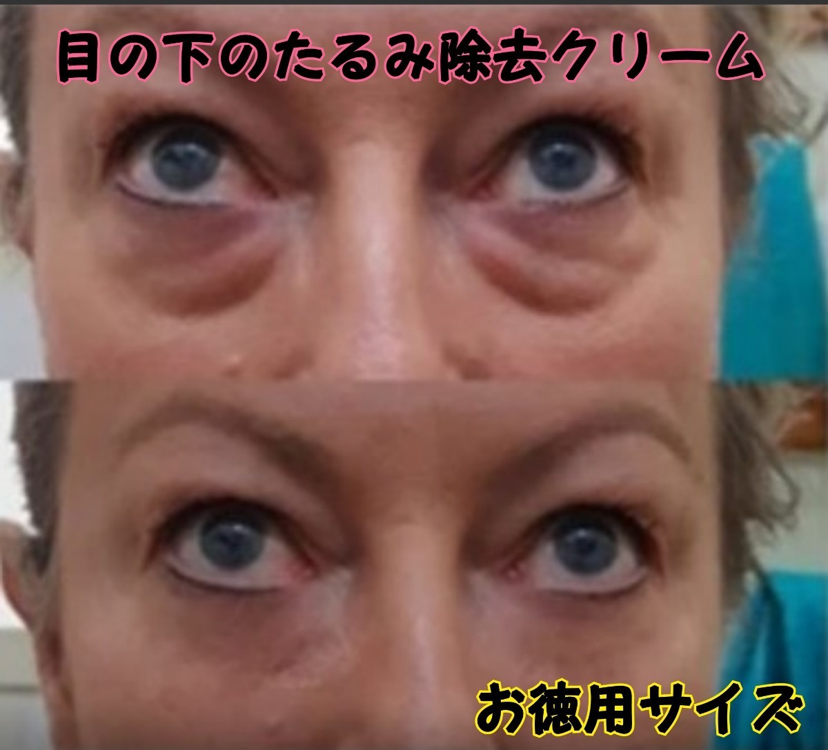 Paypayフリマ ビッグサイズ 目の下のたるみシワ改善クリーム おでこや首のシワ浮腫除去にも Paypayフリマ ビッグサイズ 目の下のたるみシワ改善クリーム おでこや首のシワ浮腫除去にも