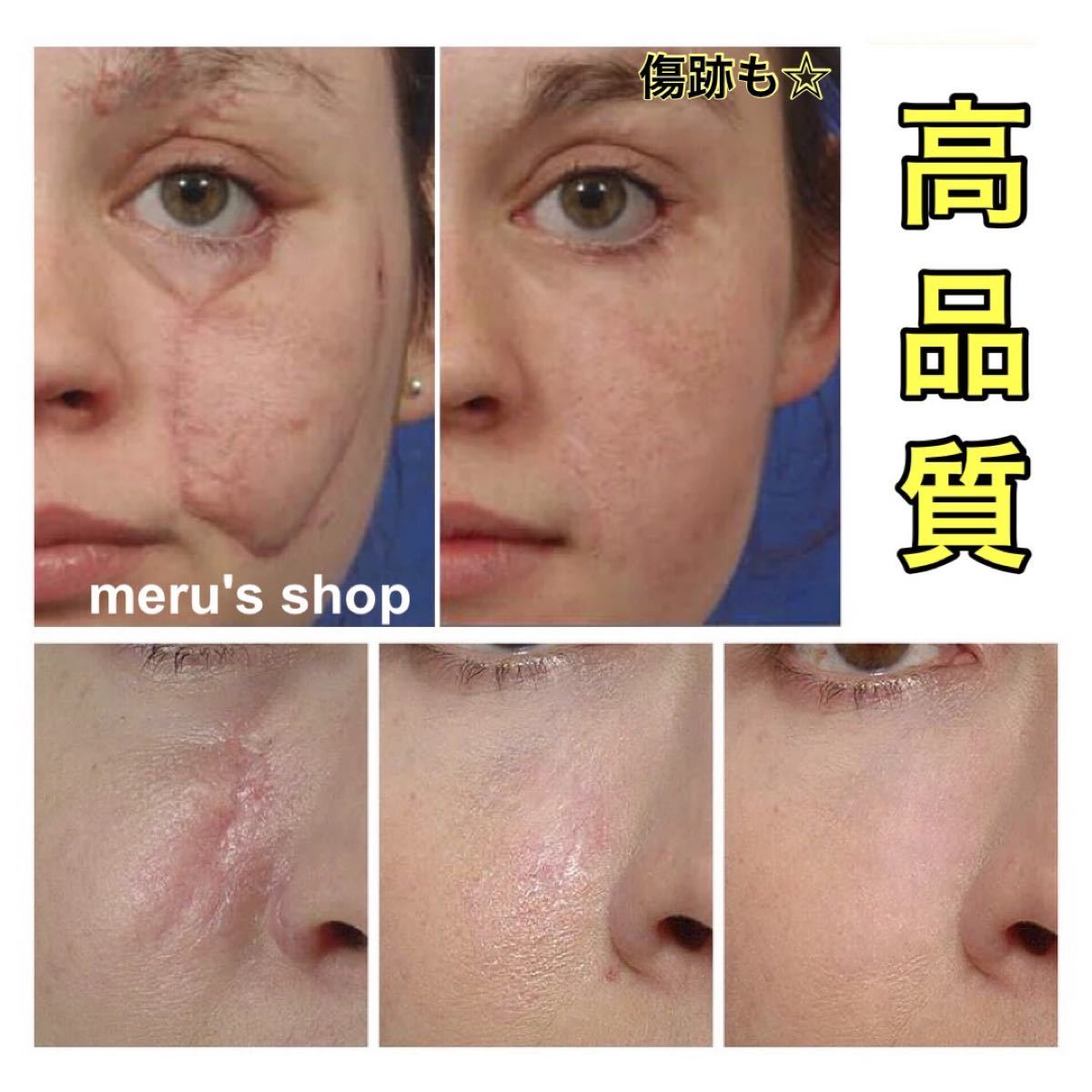 Paypayフリマ ニキビ跡クレーター 対策 ケア 高品質 美容液 Paypayフリマ ニキビ跡クレーター 対策 ケア 高品質 美容液