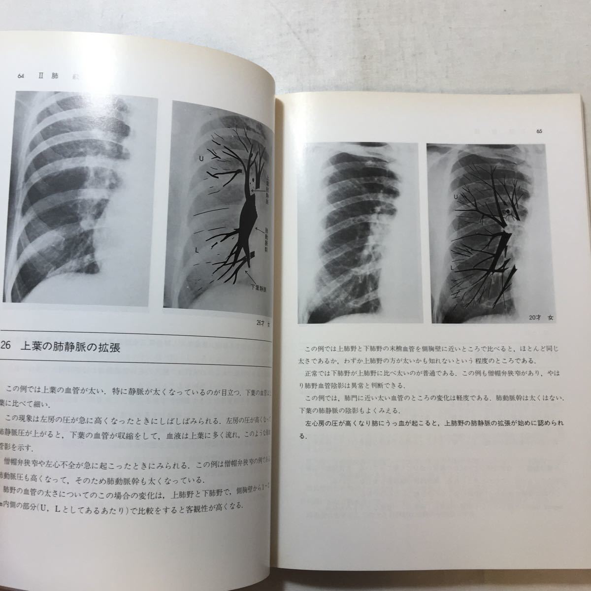 zaa-254♪胸部X線読影テキスト 単行本 1980/2/1 田坂晧 (著)　文光堂_画像7