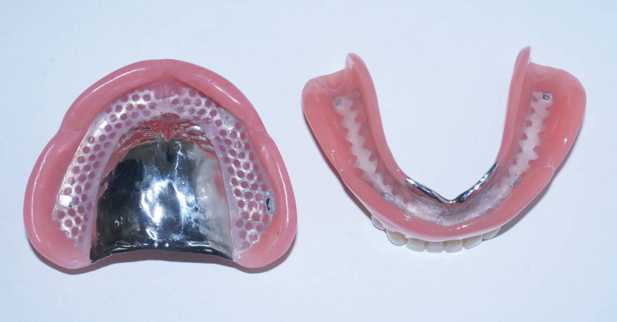 歯科 総義歯 金属床 サンプル 模型 見本 入れ歯 補綴 フルデンチャー