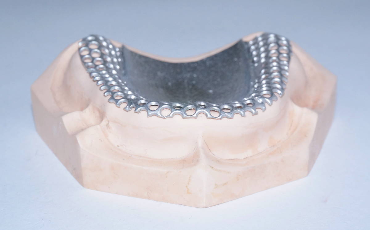 歯科 総義歯 金属床 サンプル 模型 見本 入れ歯 補綴 フルデンチャー 説明 技工 自費 メタル 資料 総入れ歯 インプラント　3