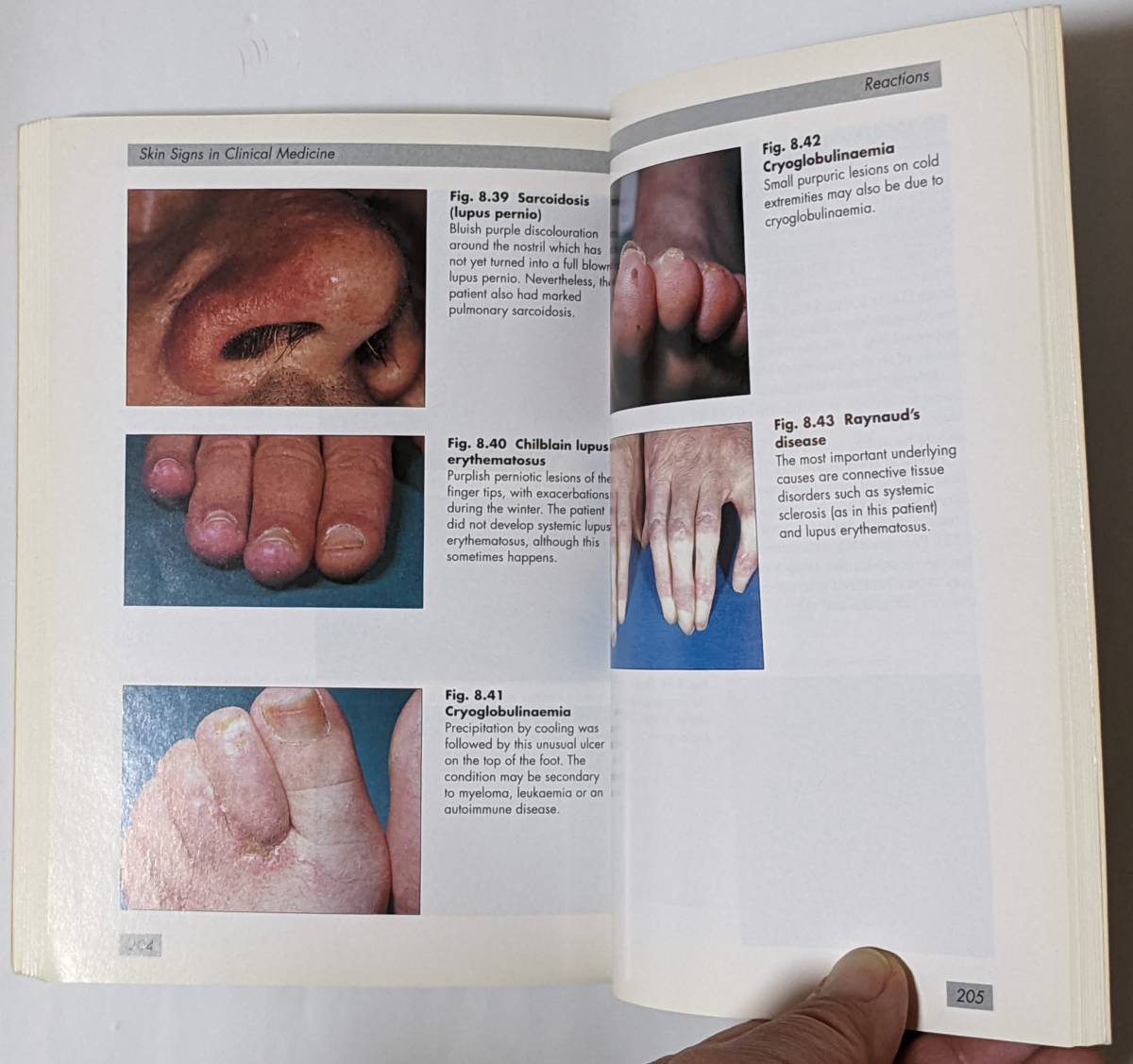 皮膚に現れる兆候から全身性疾患を診断するテキスト[Skin Signs in Clinical Medicine]英語/1997年発行/カラー図版/乾癬/湿疹_画像8