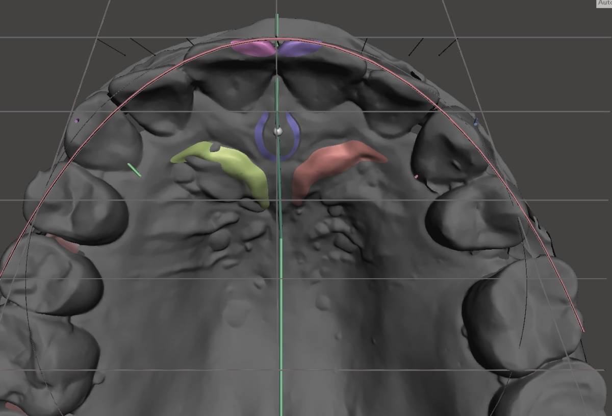 歯科 歯科技工 デジタルデザインツール 上顎無歯顎前歯配列ガイド 口蓋皺襞・切歯乳頭ポジションガイド .stl mp4動画 の画像3