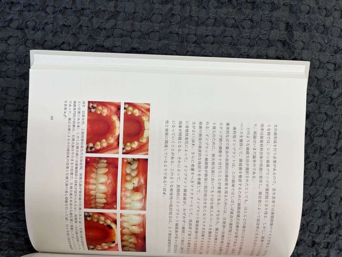 スカンジナビアンアプローチ クラウンブリッジの臨床 www.lram-fgr.ma