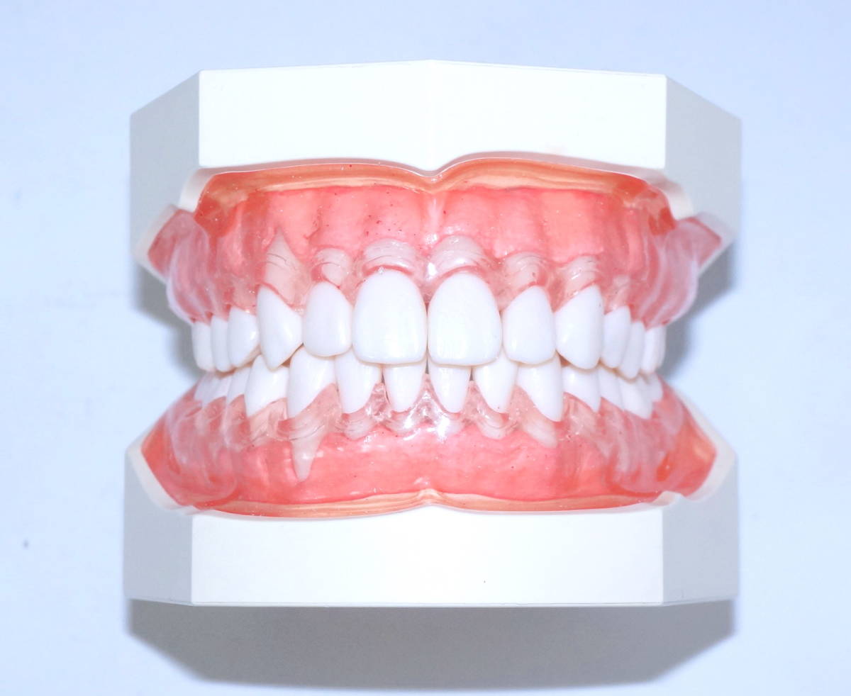 NISSIN 歯周病 歯科 模型 歯周外科 顎模型 歯科衛生士 ニッシン スケーリング スケーラー SRP 歯石 マネキン 超音波 ペリオ 舌 4_画像4