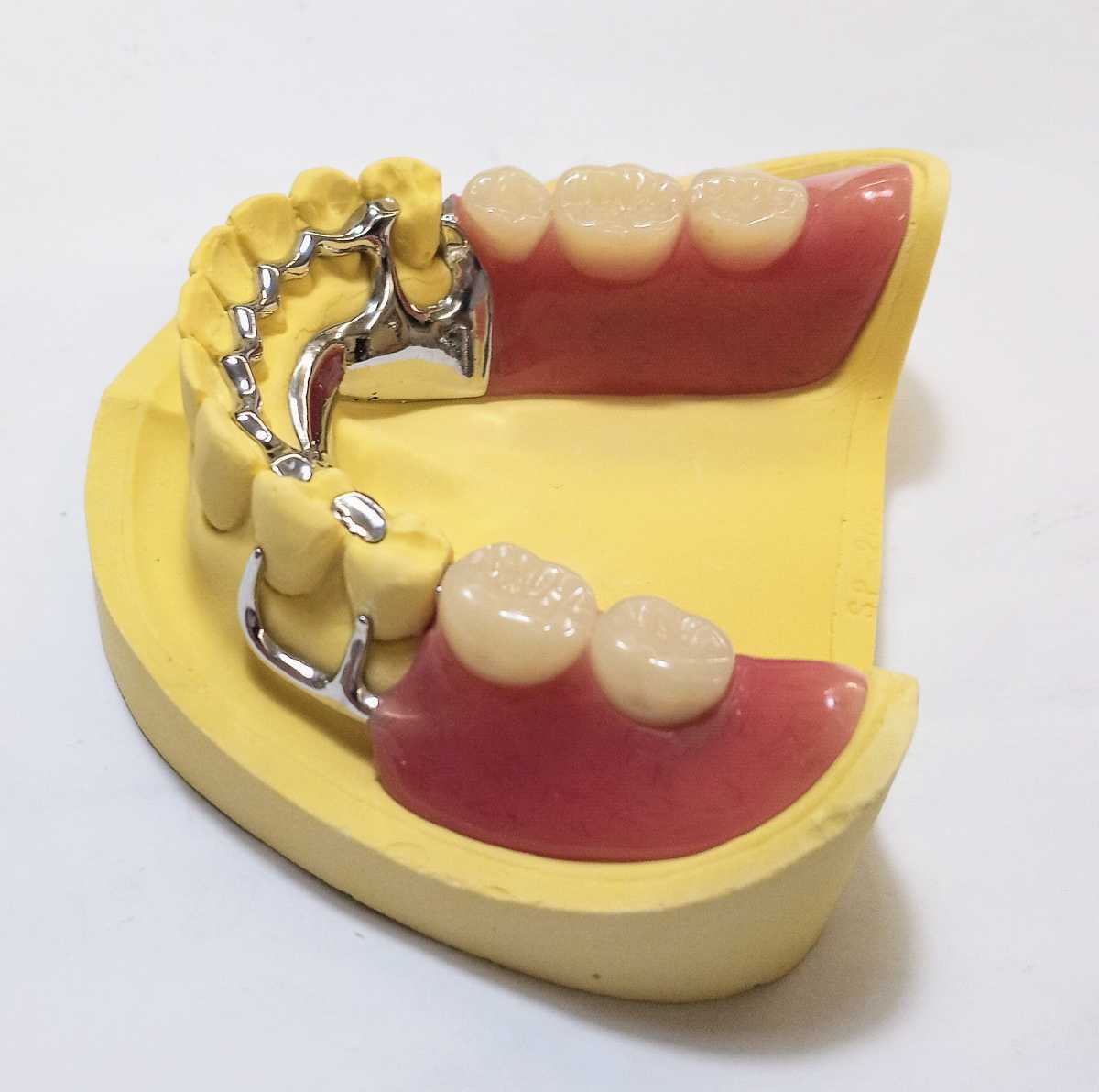 送料込み 下顎金属床 歯科 サンプル 見本 入れ歯 パーシャル 部分床 歯科技工 自費 資料