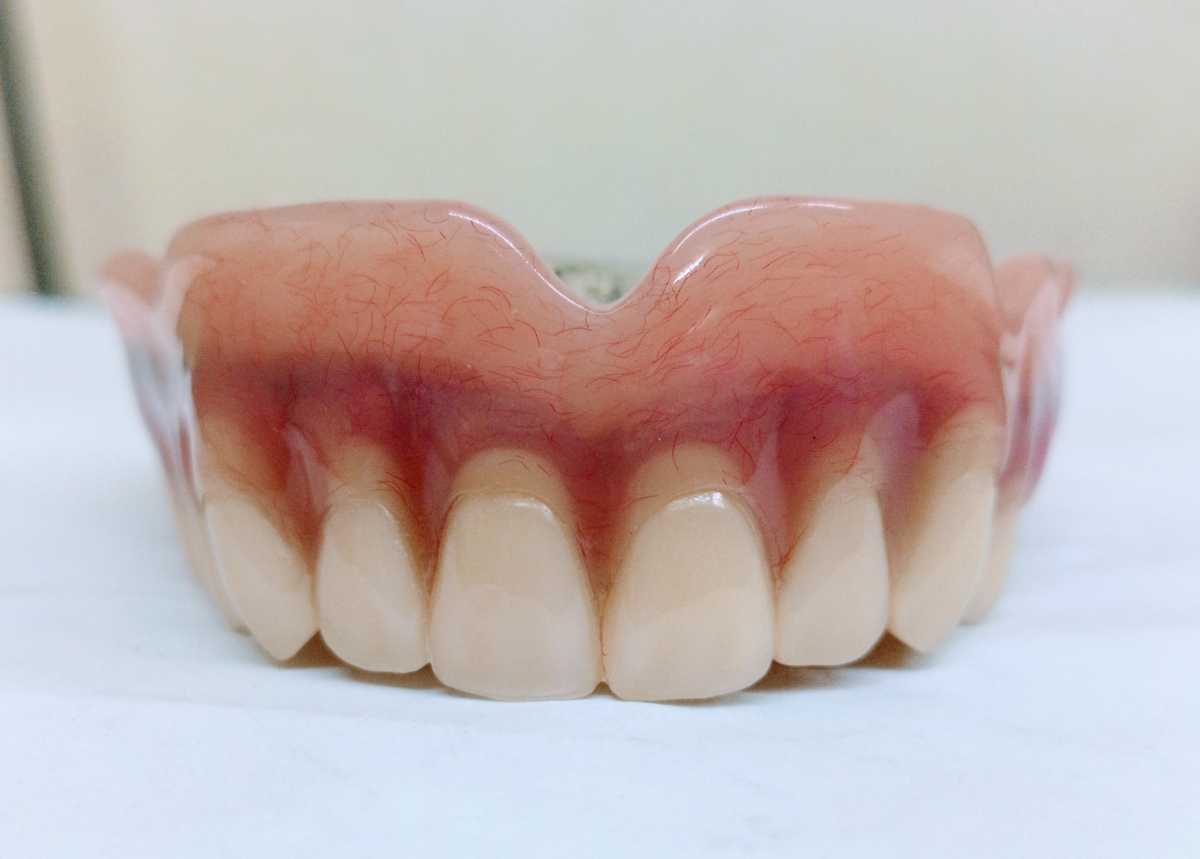 送料込み 上顎金属床 歯科 サンプル 見本 入れ歯 総義歯 フル