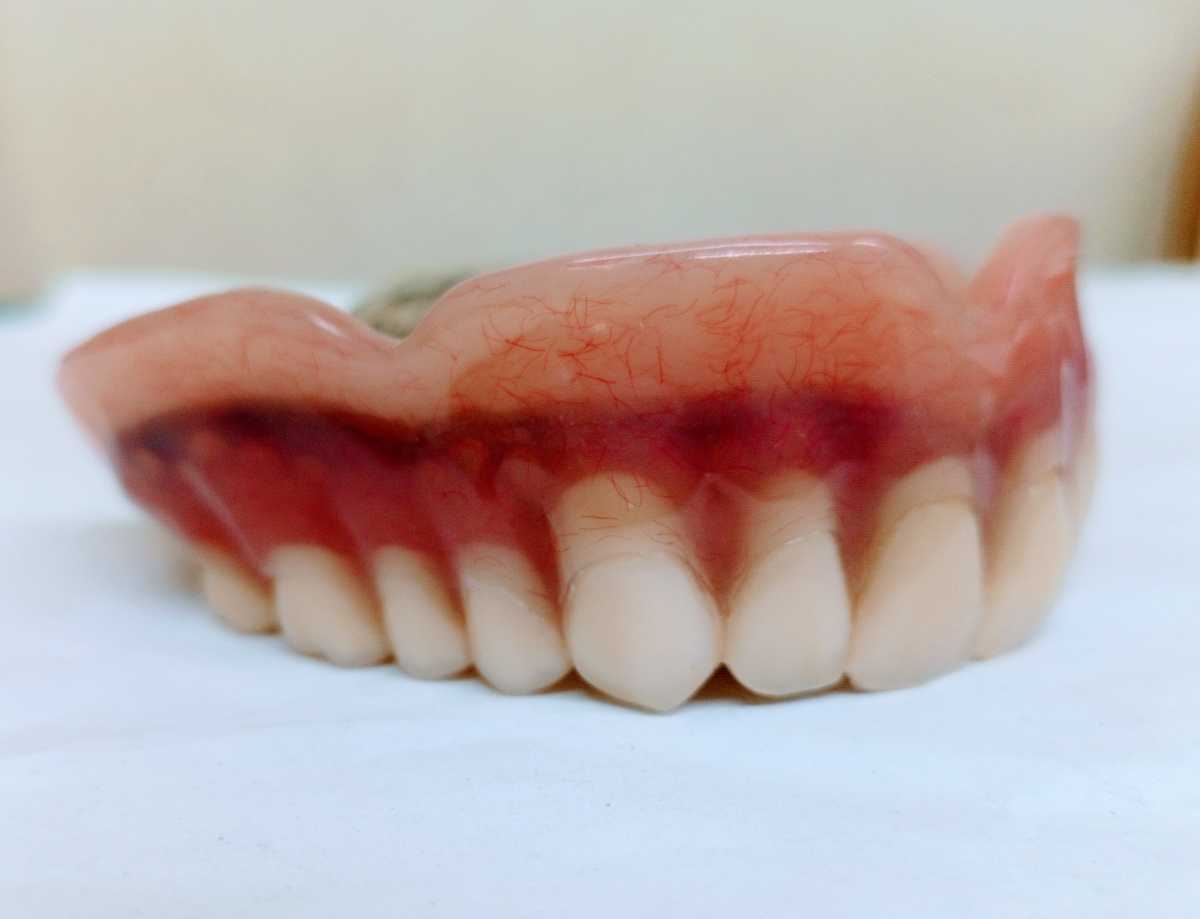 送料込み 上顎金属床 歯科 サンプル 見本 入れ歯 総義歯 フル