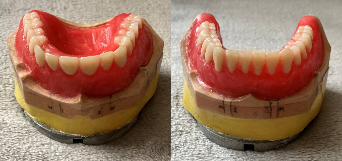 ヤフオク! - ◎【 歯科技工 】入れ歯 サンプル 義歯 歯科模型 入れ歯...