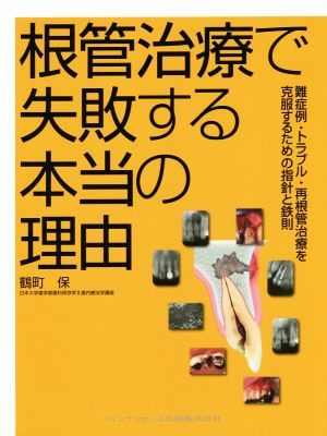 根管治療で失敗する本当の理由 難症例・トラブル・再根管治療を克服するための指針と鉄則／鶴町保(著者)_画像1