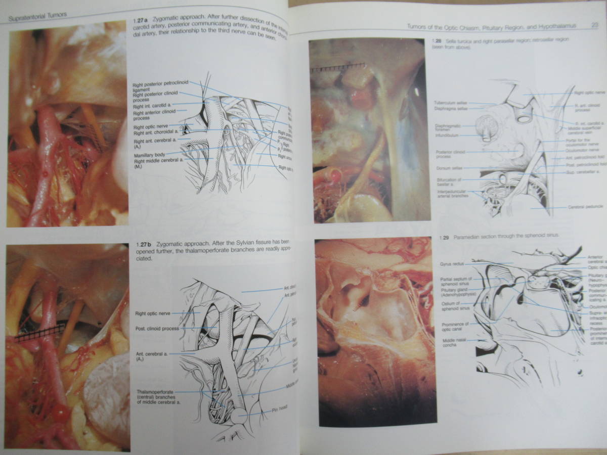 J06●Thieme Color Atlas of Microneurosurgery 3冊＋他2冊 計5冊セット 洋書 医学書 微小神経外科 カラーアトラス 頭蓋神経 230322_画像8