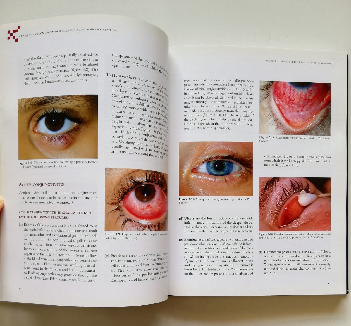 b12. 【洋書・英語】Blepharitis and Conjunctivitis. Guidelines for Diagnosis and Treatment 眼科 参考書籍_画像5