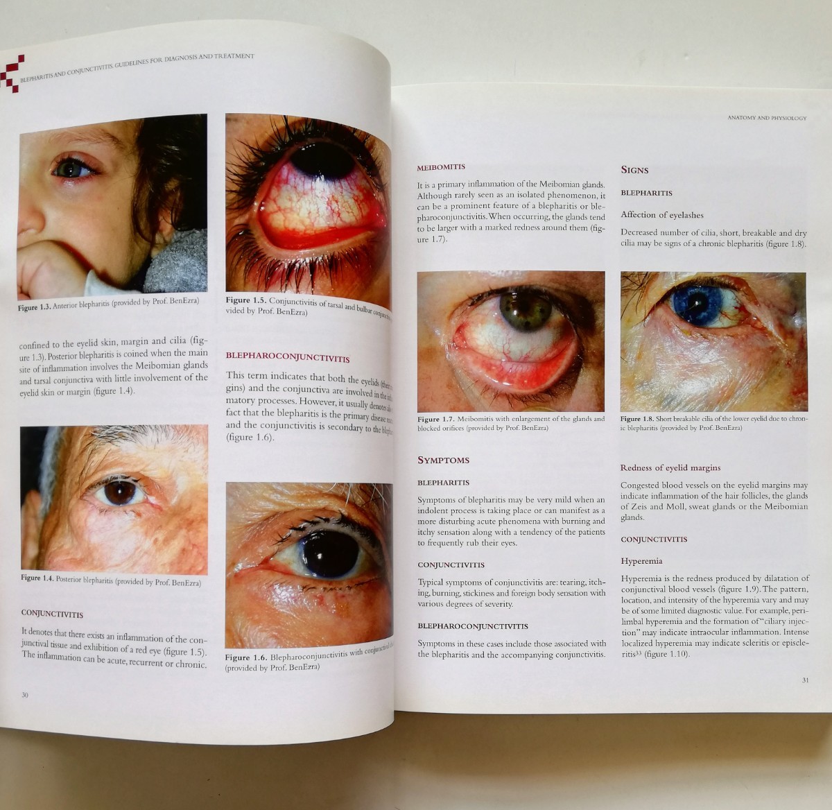 b12. 【洋書・英語】Blepharitis and Conjunctivitis. Guidelines for Diagnosis and Treatment 眼科 参考書籍_画像4