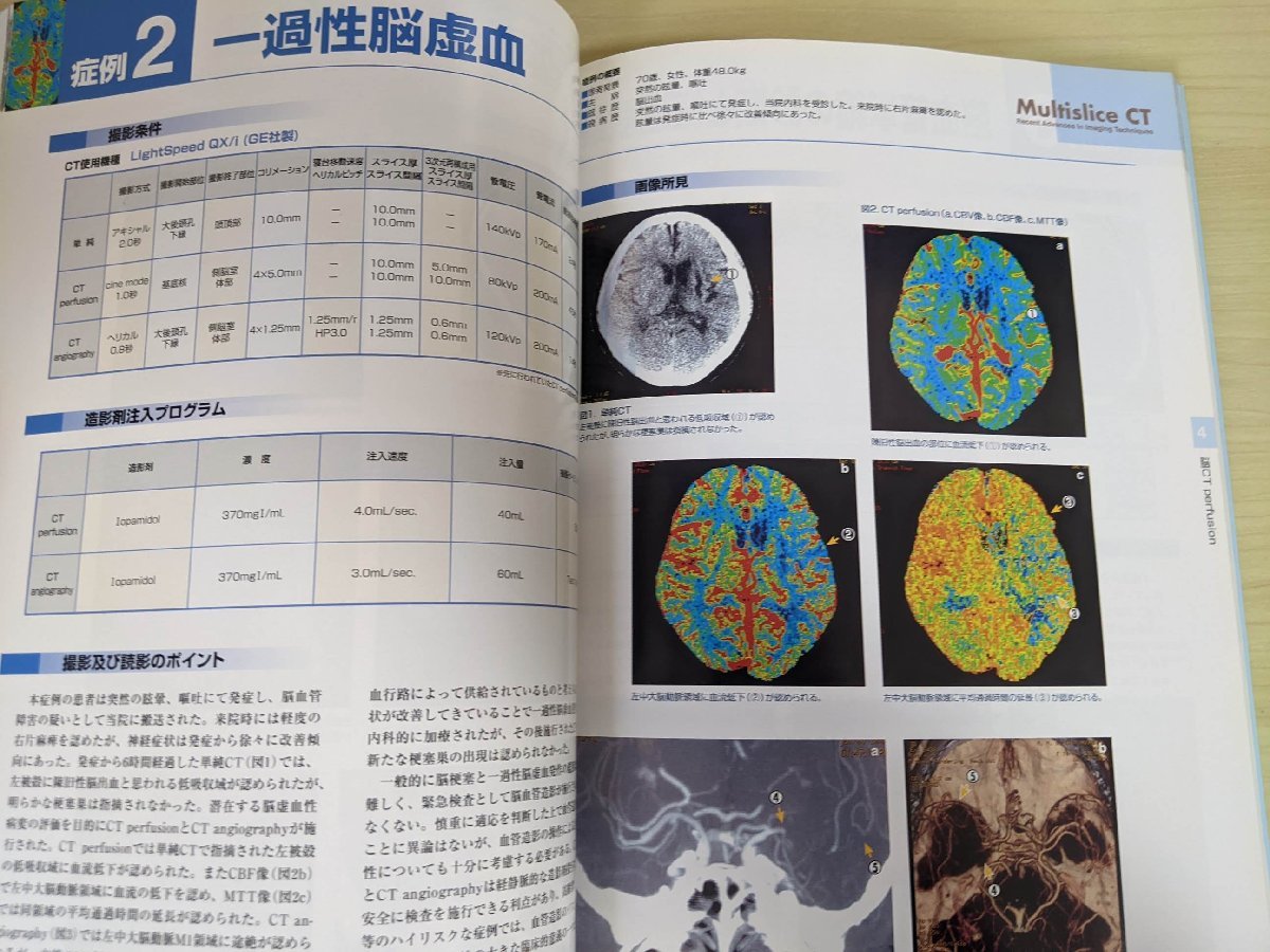 マルチスライスCT 進化論 2004/肺動脈血栓塞栓症/食道癌/大腸脂肪腫/泌尿生殖器/急性心筋梗塞/閉塞性血栓血管炎/高安病/医学/医療/B3220643_画像2