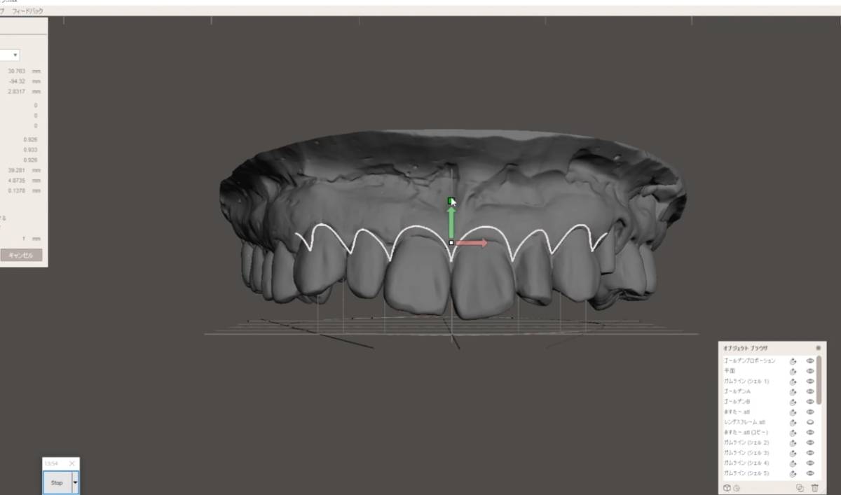 歯科　歯科技工　デジタルクラウンレングスニングガイドデータ作成手順動画　mp4 meshmixer_画像7
