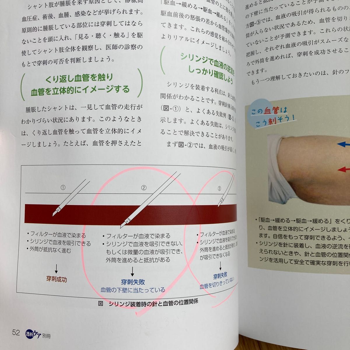 透析ケア別冊 透析穿刺スキルアップBOOK|Yahoo!フリマ(旧 透析ケア別冊 透析穿刺スキルアップBOOK|Yahoo!フリマ(旧