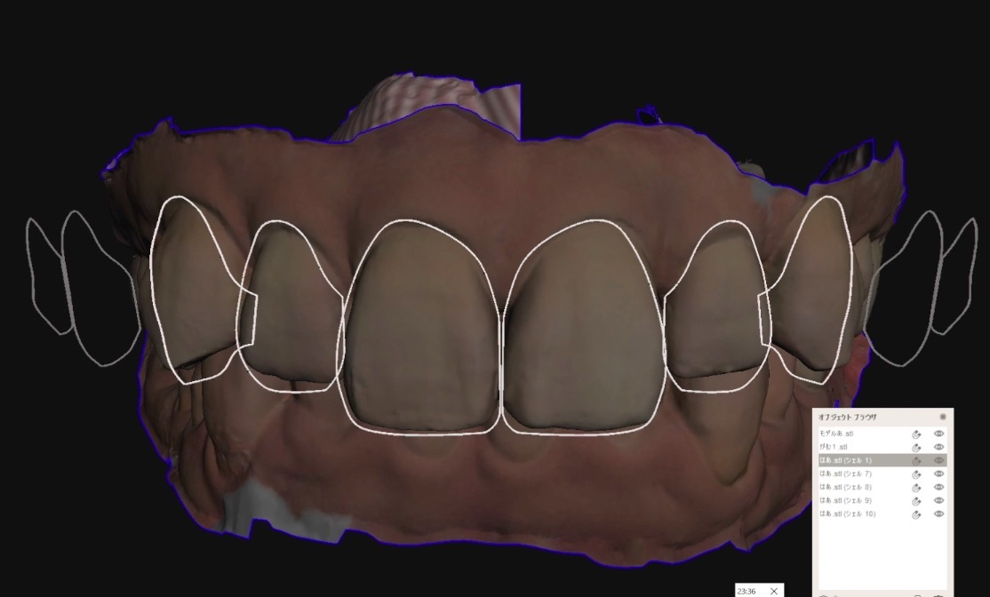 歯科　歯科技工　ティーステンプレート　ガムラインテンプレート　stl　審美・診断用テンプレート　デジタルデザインツール