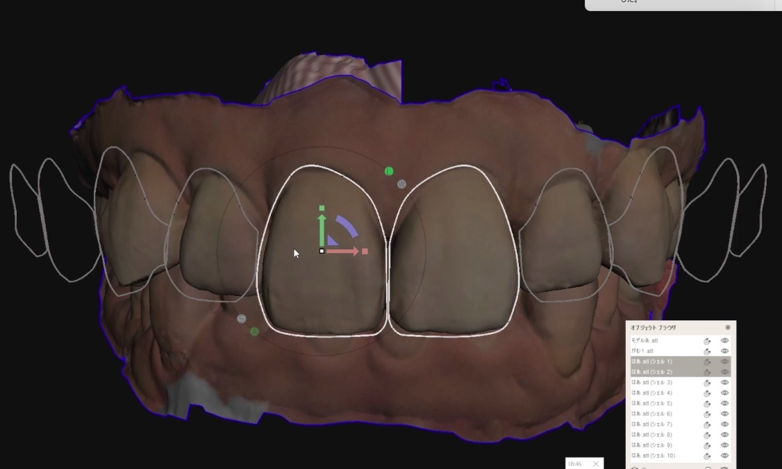 歯科 歯科技工 ティーステンプレート ガムラインテンプレート stl 審美・診断用テンプレート デジタルデザインツールの画像10