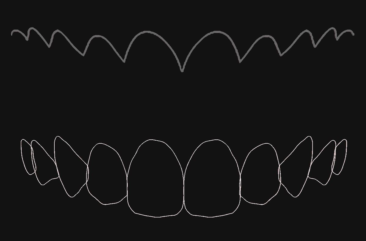 歯科 歯科技工 ティーステンプレート ガムラインテンプレート stl 審美・診断用テンプレート デジタルデザインツールの画像4
