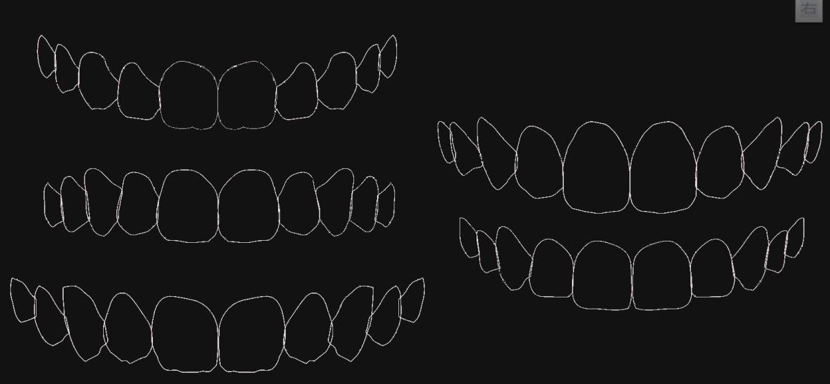 歯科 歯科技工 ティーステンプレート ガムラインテンプレート stl 審美・診断用テンプレート デジタルデザインツールの画像5