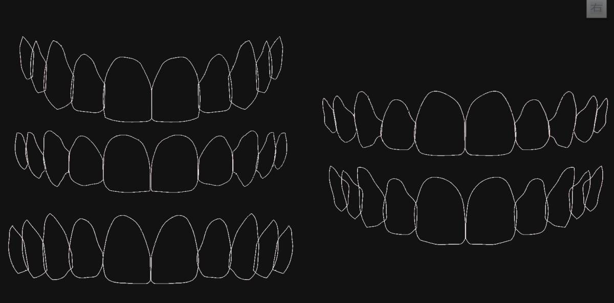 歯科 歯科技工 ティーステンプレート ガムラインテンプレート stl 審美・診断用テンプレート デジタルデザインツールの画像6