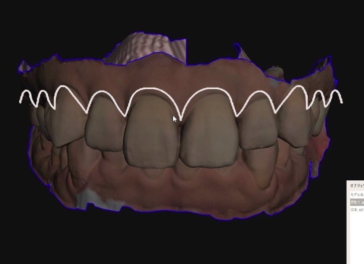 歯科 歯科技工 ティーステンプレート ガムラインテンプレート stl 審美・診断用テンプレート デジタルデザインツールの画像8