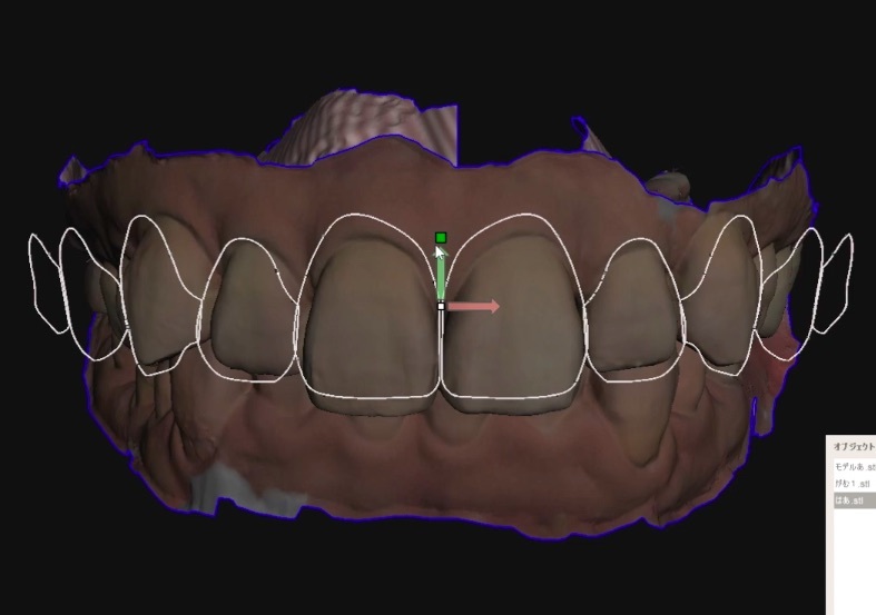歯科 歯科技工 ティーステンプレート ガムラインテンプレート stl 審美・診断用テンプレート デジタルデザインツールの画像9