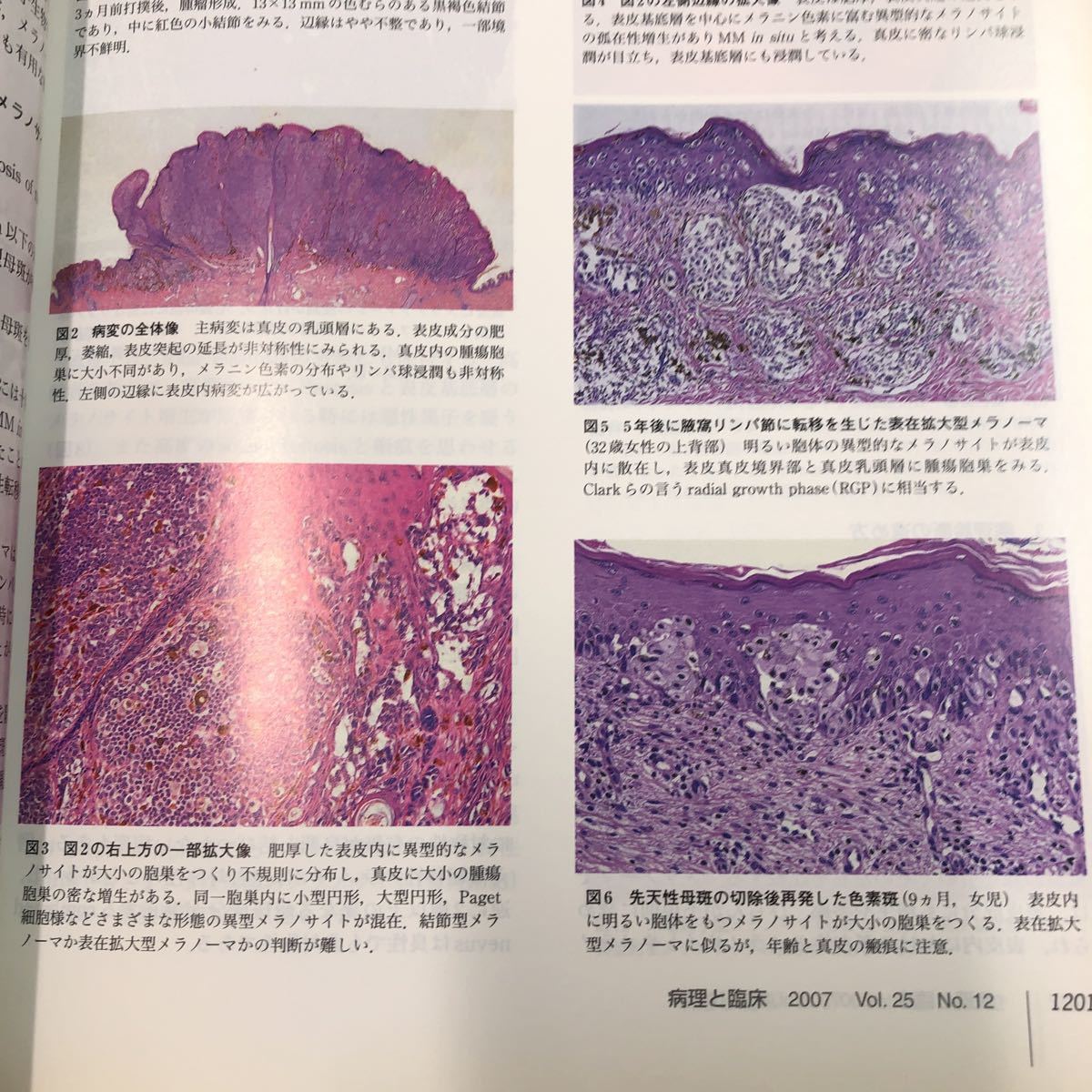 S6h-234 病理と臨床 2007年12月号 vol.25 No.12 メラノーマの診断 平成19年12月1日 発行 文光堂 医学 研究 雑誌 病理学 臨床 メラノーマ_画像6