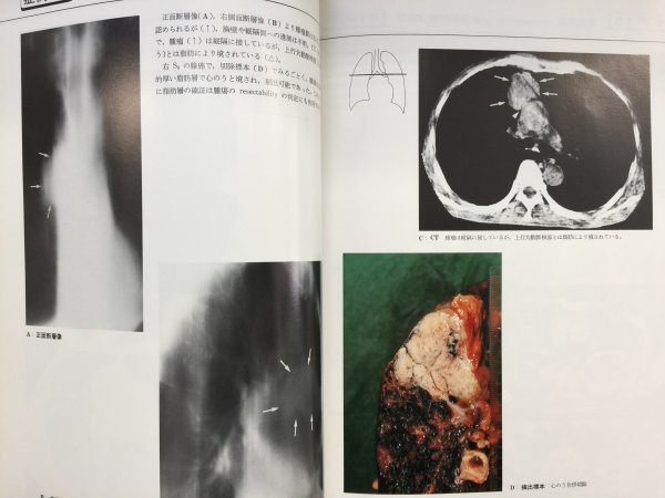 特3 82228 / 胸部のCTの読み方 1987年7月15日発行 胸部CT検査法と適応 正常胸部CT解剖 胸部疾患のCT所見 結核腫 書き込みあり_画像5