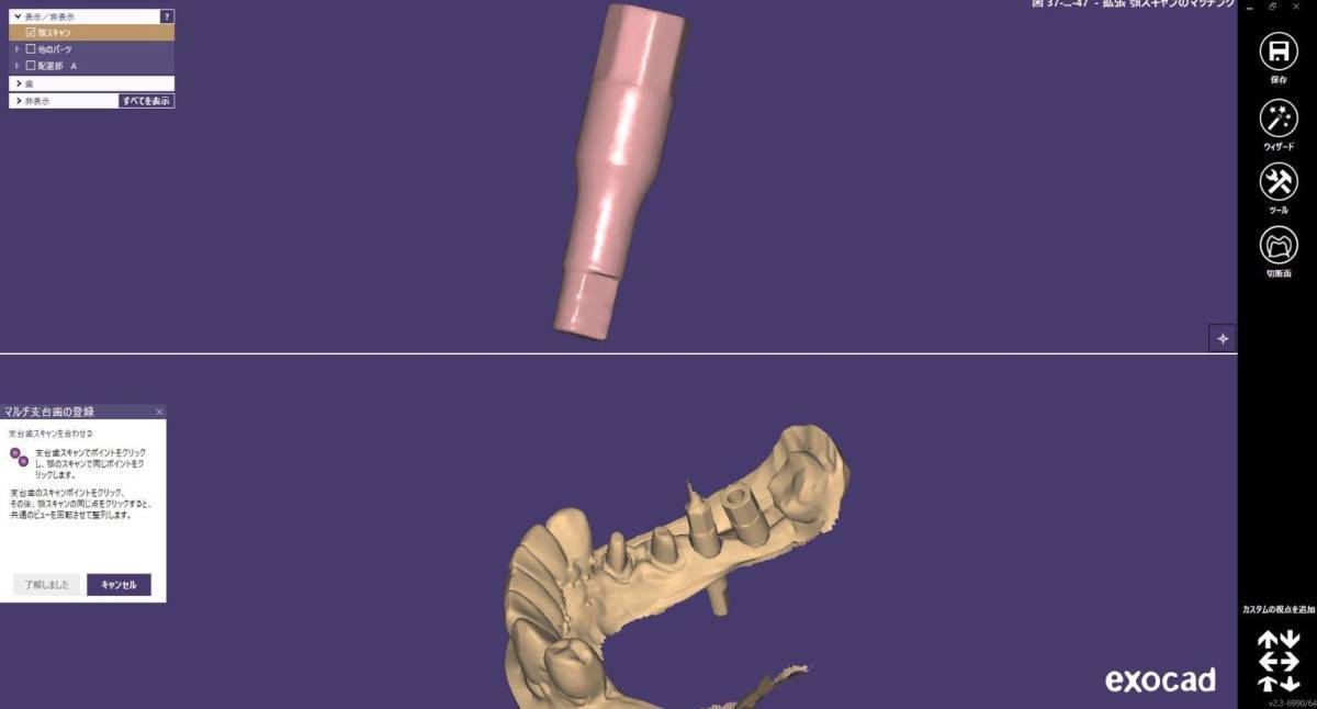 歯科 歯科技工 3Dプリントにインプラントレプリカを戻すための製作手順書 Meshmixer+Labo Scannerの画像3