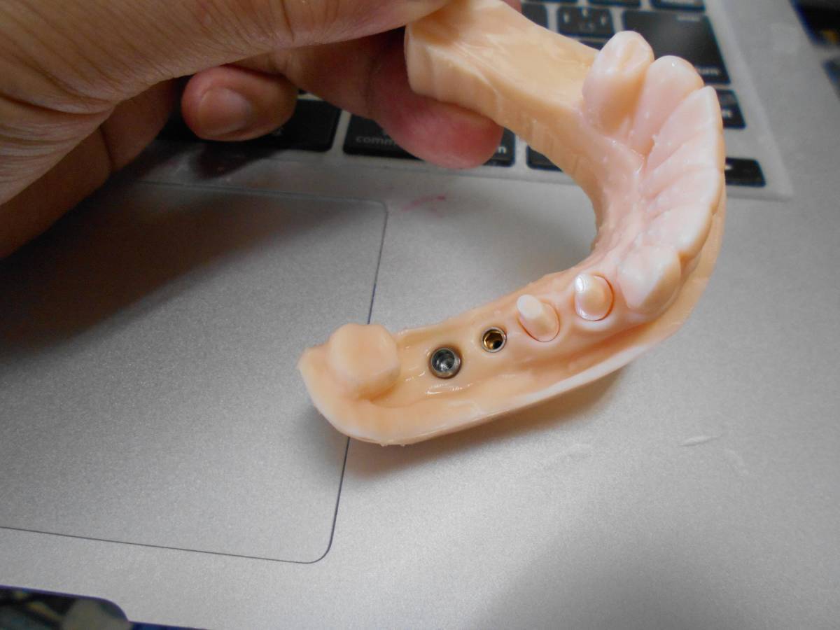 歯科 歯科技工 3Dプリントにインプラントレプリカを戻すための製作手順書 Meshmixer+Labo Scannerの画像1