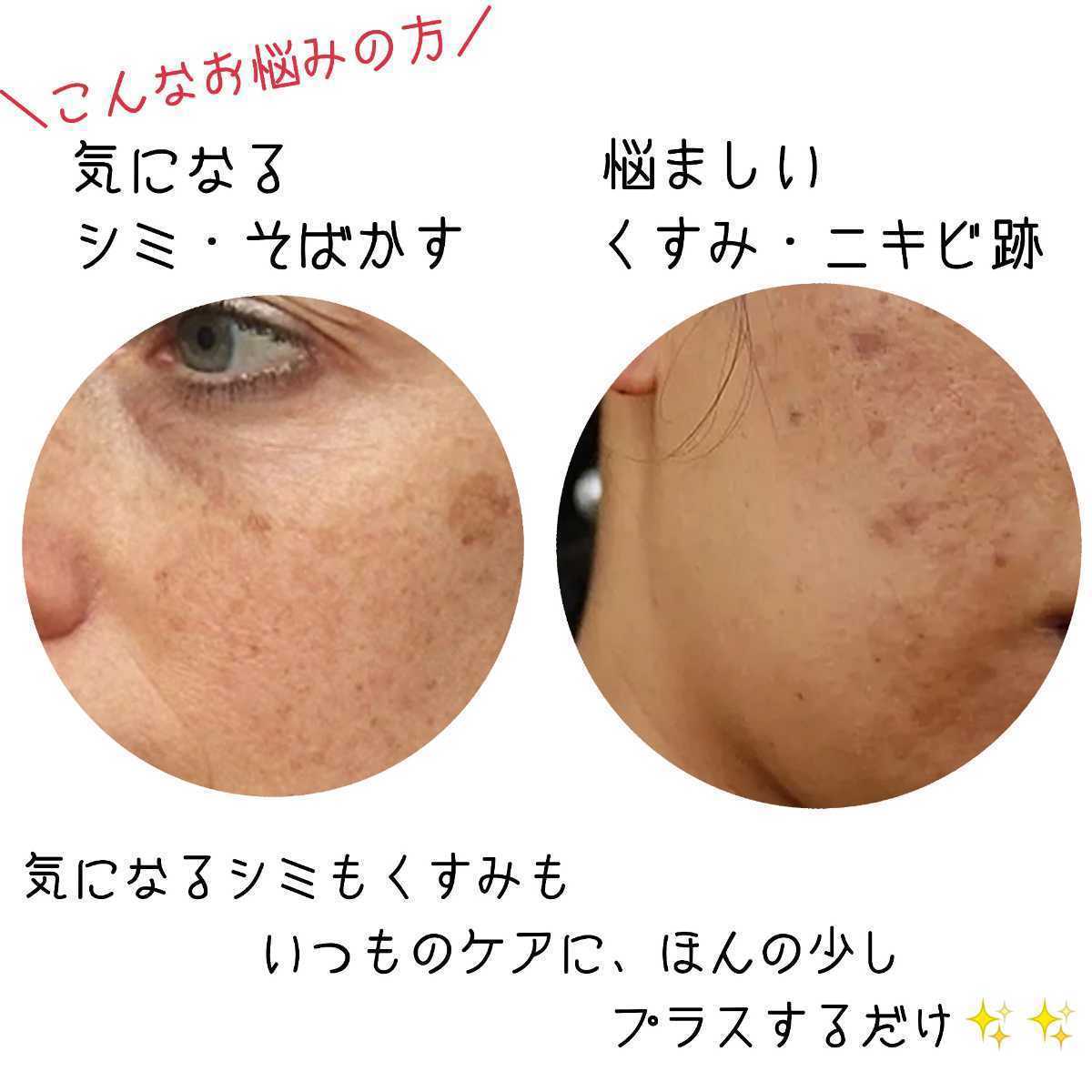 強力シミケアクリーム×20%高濃度ビタミンC美容液　シミケア　シミ消し　色素沈着　くすみ　美白　毛穴　そばかす　ニキビ跡　ほうれい線_画像9