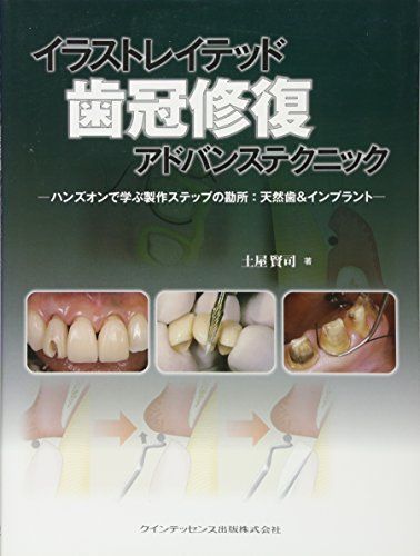 [A12197399]イラストレイテッド　歯冠修復　アドバンステクニック (イラストレイテッドシリーズ) [単行本（ソフトカバー）] 土屋 賢司