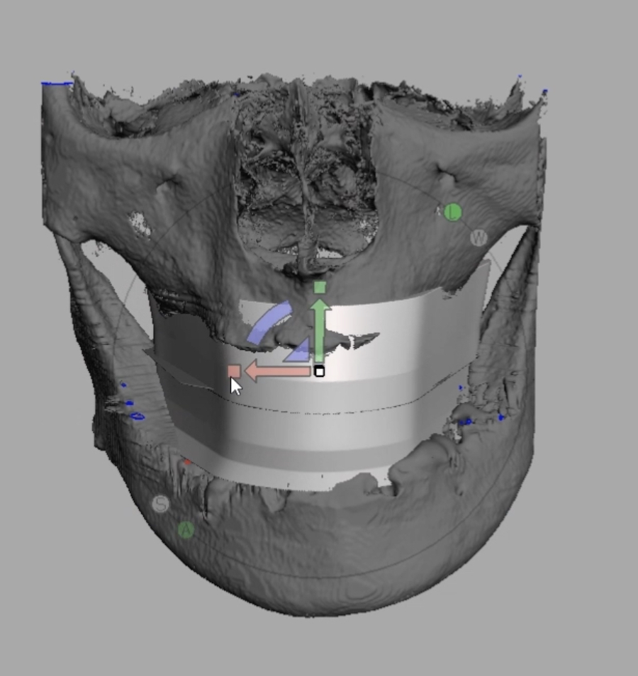歯科 歯科技工 3D骨データ上の仮想咬合平面設定方法 mp4動画 テンプレート セファロの画像7