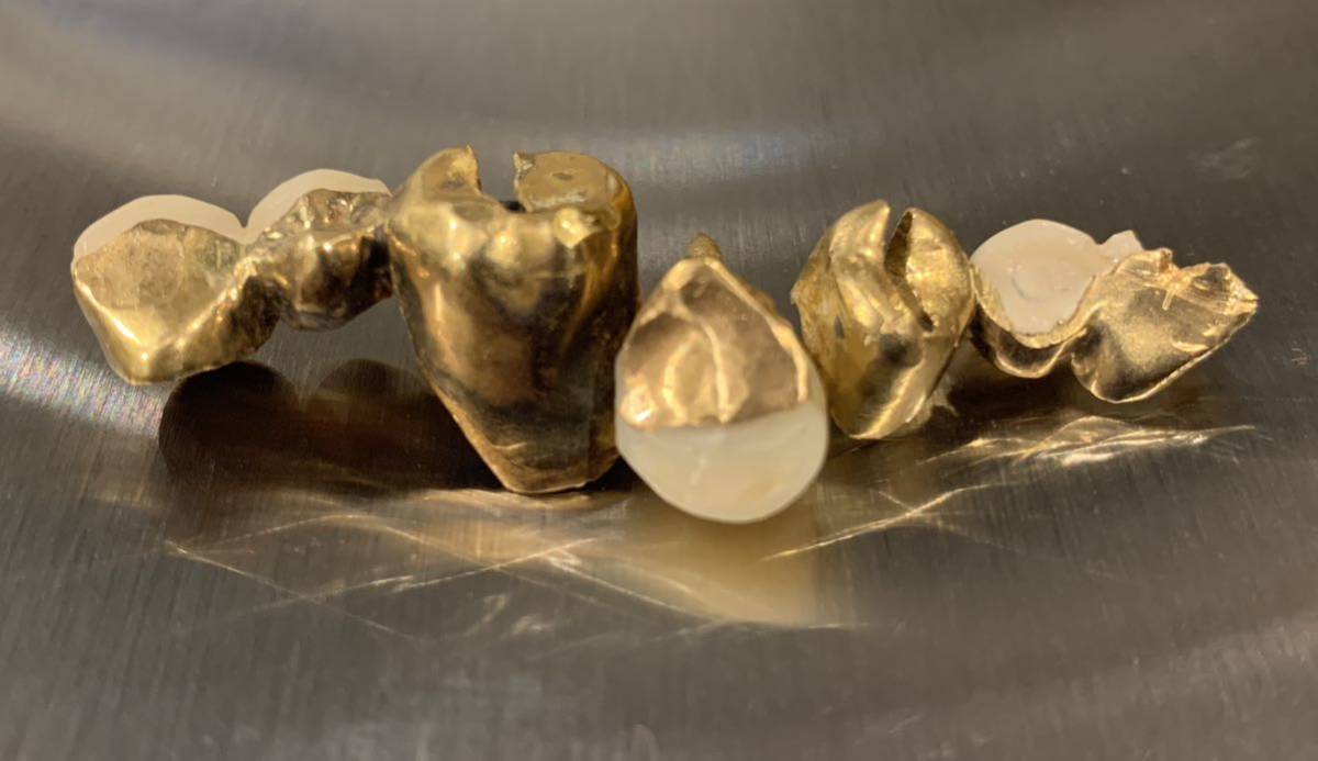金歯 歯科金属 被せ物 入れ歯 オーラルケア 総重量約17.40g まとめて プラチナ 遺品整理_画像10