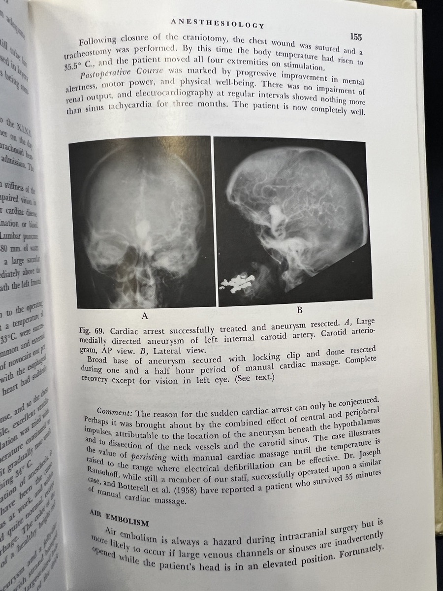 Aneurysms and Arteriovenous Anomalies of the Brain ハード Aneurysms and Arteriovenous Anomalies of the Brain ハード