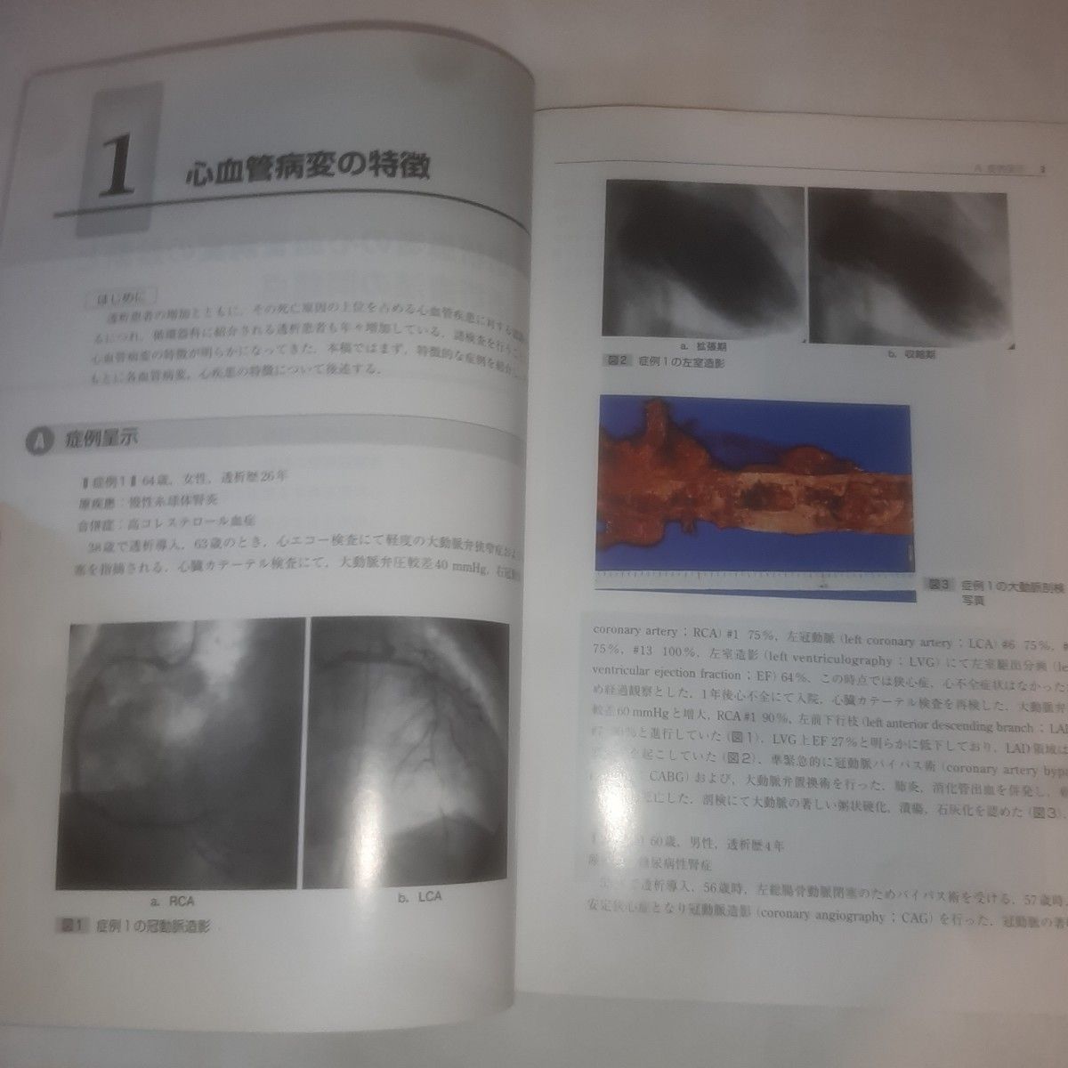 透析患者の循環器疾患に対する最新治療　透析医・循環器内科医・心臓外科医の立場から 小坂真一／総編集　杉本徳一郎／編集　木村剛／編集