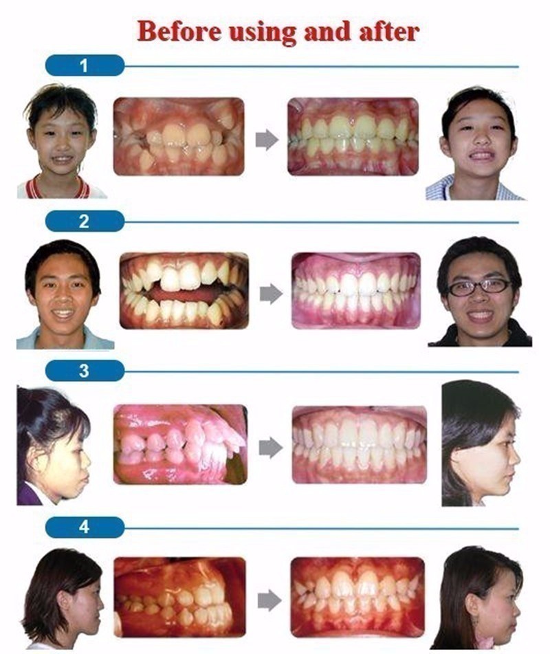 上下マウスピース 歯保護 歯列矯正 歯ぎしり いびき防止の画像5
