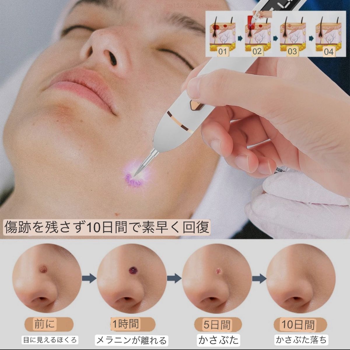 新品】シミ取り レーザーペン タトゥー除去 美顔器 針15本 シミ 新品】シミ取り レーザーペン タトゥー除去 美顔器 針15本 シミ