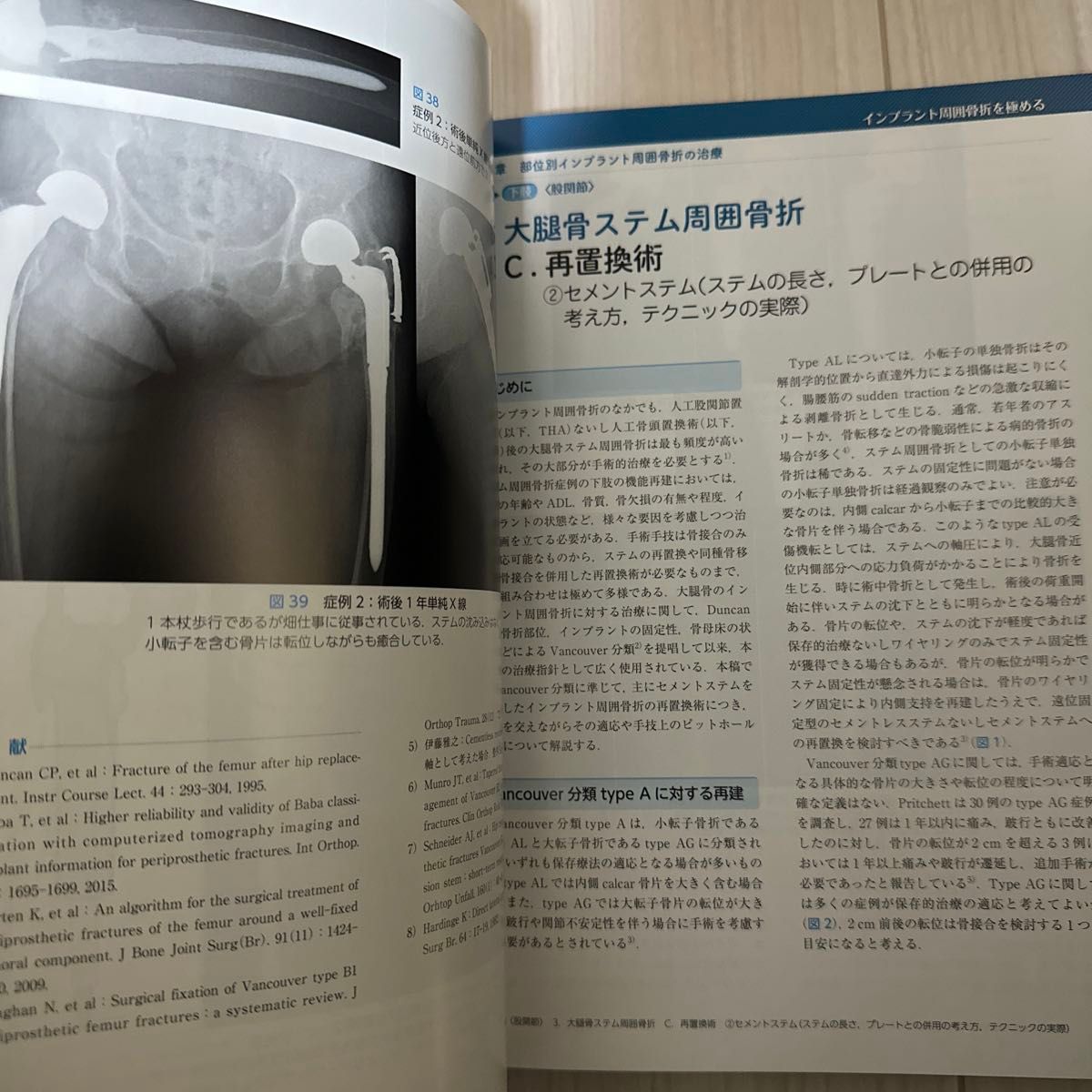 インプラント周囲骨折を極める - 本 インプラント周囲骨折を極める - 本