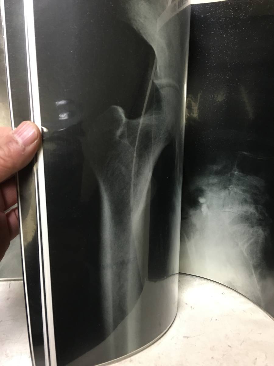 即決　X線フィルムから診断する骨粗鬆症　林 二史_画像6