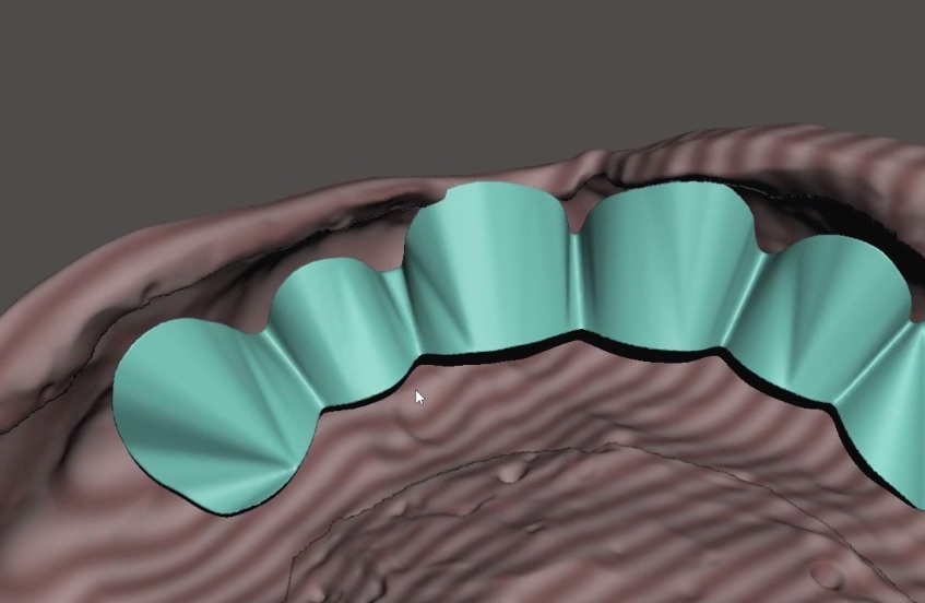歯科　歯科技工　義歯スキャンデータからコピーデンチャーのデータ製作　義歯データからのモデルデータ製作手順動画　mp4_画像5