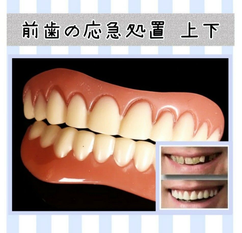 歯の応急処置　 前歯のカバー
