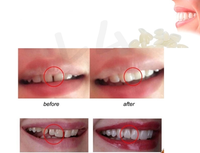* ordinary mai shipping * temporary tooth 28 piece set & 10 gram . tooth gong kyula fitting beads No.871 2