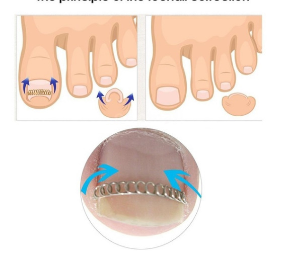 M24 巻き爪 矯正 足指 変形 矯正ワイヤーペディキュア 治療 痛い巻き爪 便利 6本/セット_画像2