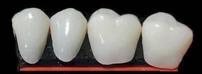 高品質義歯 歯科人工義歯 下段奥歯 奥歯全４個セット 義歯 仮歯 付け歯 入れ歯 インスタントスマイル 粘着素材セット 抜けた歯を補修 D