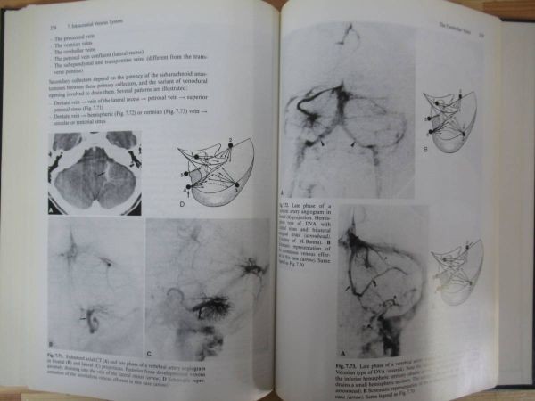 L93●洋書 Surgical Neuro angiography Volume 3 Functional Vascular Anatomy of Brain Spinal Cord and Spine 医学書　 230306_画像9